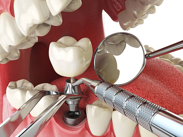 Best Chipped Tooth Repair Near Me  in Florida, NY